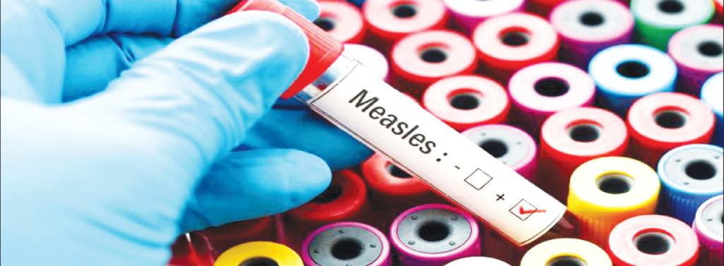 Measles